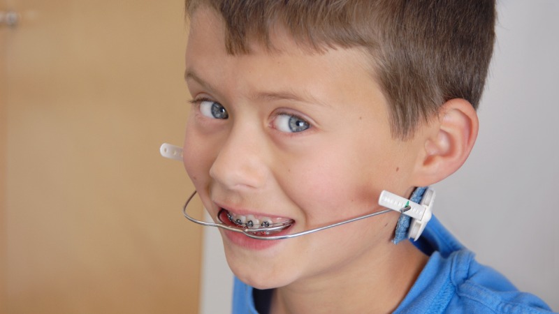 apparaten met extra orale kracht orthodontie